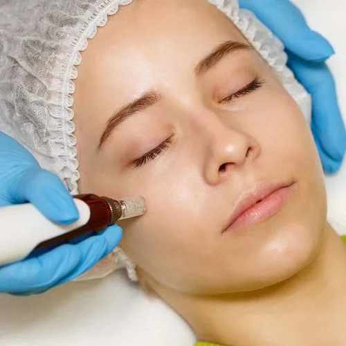 RF Microneedling - Med Lounge, Orange County CA