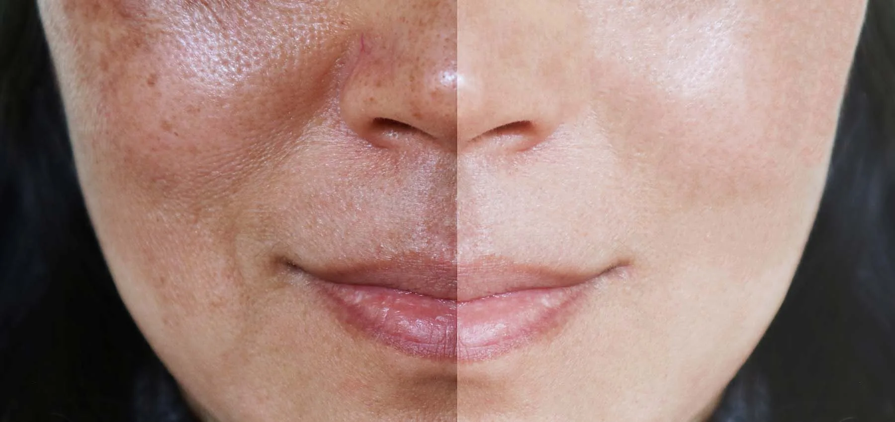 DMK Skin Revision - Med Lounge, Orange County CA