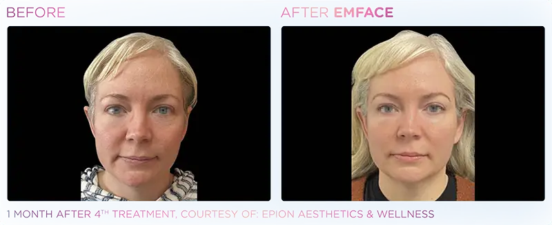 BTL EmFace